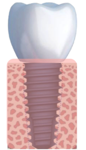 Implantologia - Impianto singolo