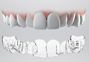 Ortodonzia invisibile