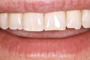 Odontoiatria restaurativa prima