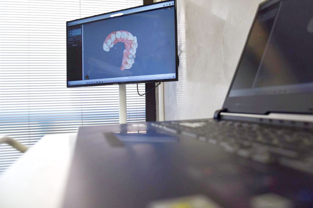 Scanner intraorale 3D