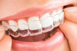 Ortodonzia invisibile