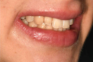 sorriso destro prima